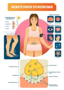 Infographic titled “Serotonin Syndrome” showing symptoms around an illustrated sweating woman and a lower diagram of serotonin accumulation and receptor overstimulation.